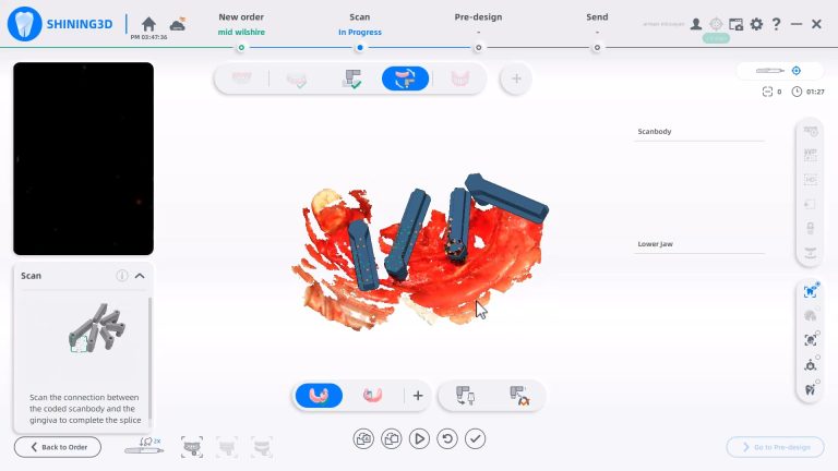 How to Use the Shining Photogrammetry and Elite Intra-Oral Scanner in Immediate Cases