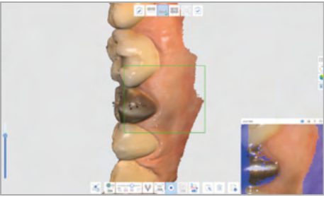 Medit iE smart metal filtering scanning a metal restoration