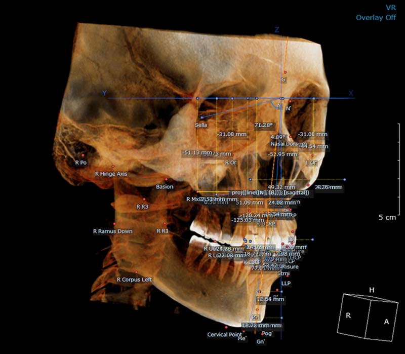 HDX WILL Dentri MAX 3D ceph view