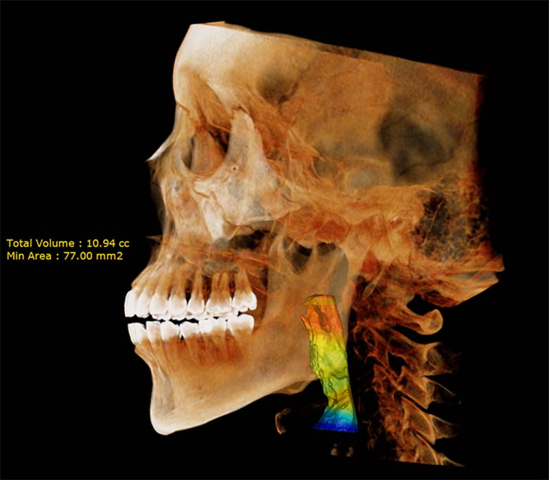HDX WILL Dentri MAX airway view