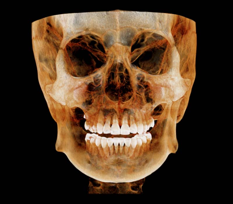 HDX WILL Dentri MAX 3D anterior view