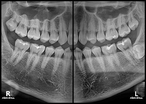 HDX WILL extraoral bitewing image