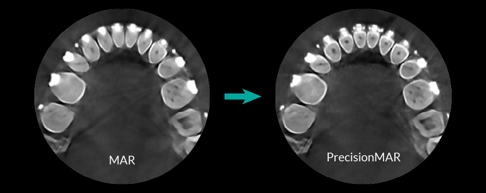 HDX WILL PrecisionMAR metal artifact reduction