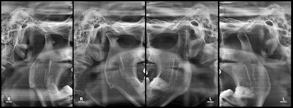 HDX WILL TMJ image