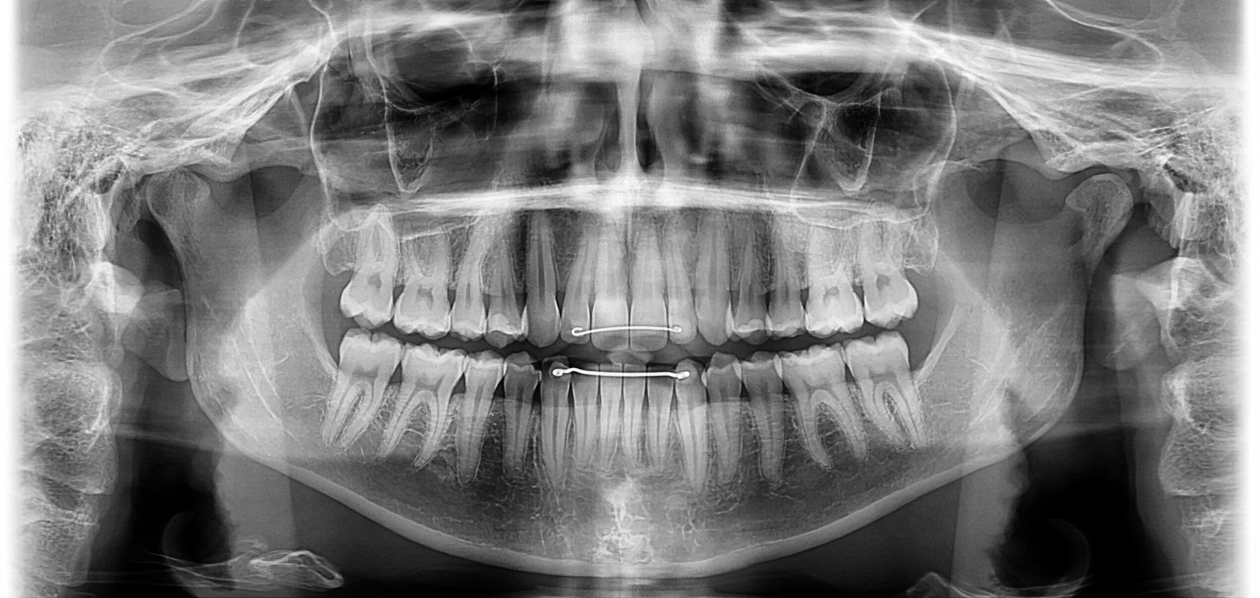 PreXion Evolve 2D enhanced ortho image