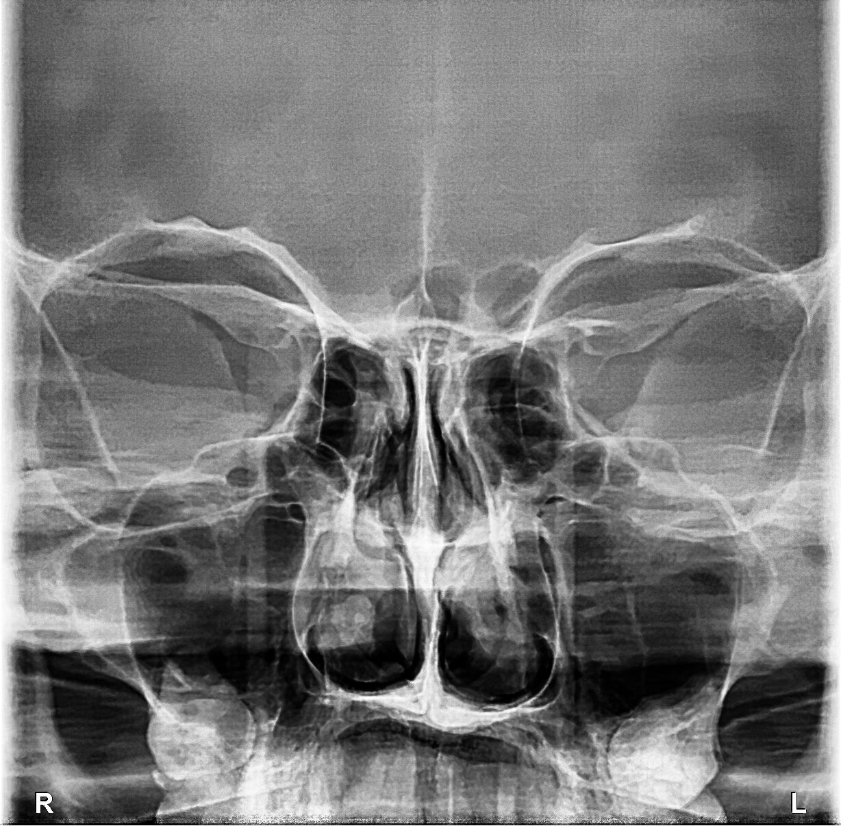 PreXion Evolve 2D AP/PA frontal ceph image