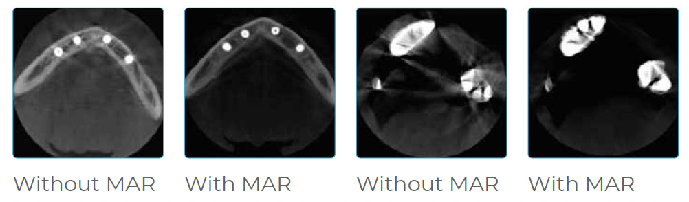 PreXion metal artifact reduction