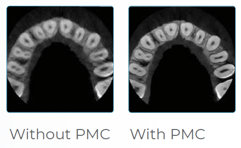 PreXion patient motion correction