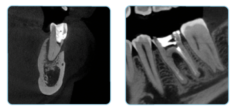 PreXion UHD mode for endodontics